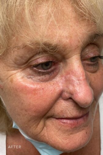 This is a photo of a woman's face with a blonde hair showing her reconstructed and restored nose appearance. | Albany, Latham, Saratoga NY, Plastic Surgery