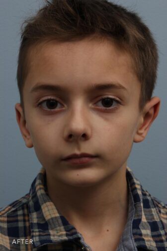 after photo of a young boy after ear surgery. His ears have been pinned back to normal position