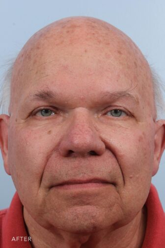After photo of an old bald man from the front angle with more eye visibility following brow lift surgery.