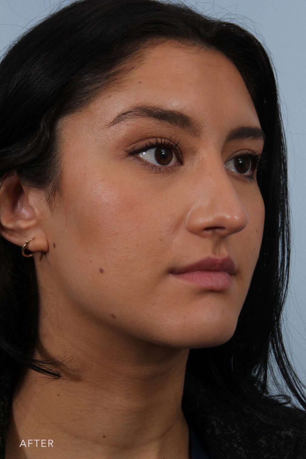 Rhinoplasty & Nasal Reconstruction Pictures | Williams Center Williams ...