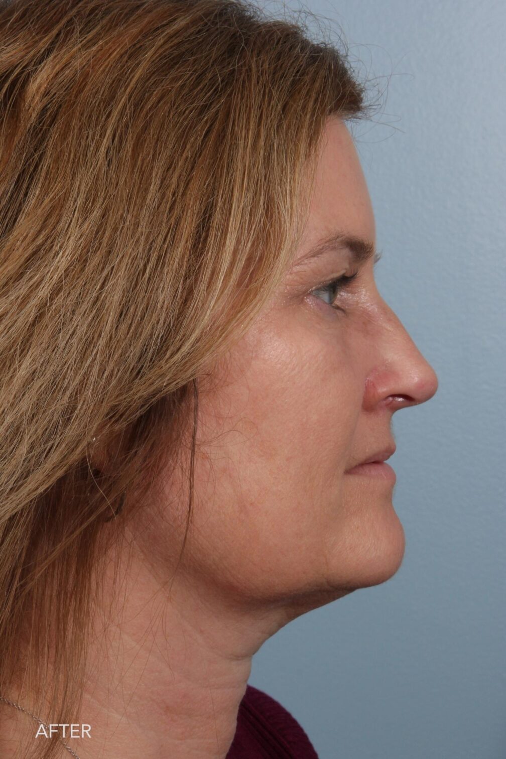 Rhinoplasty & Nasal Reconstruction Pictures | Williams Center Williams ...