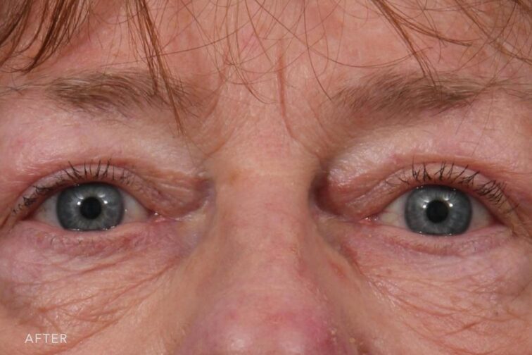 After photo of a woman's blue eyes taken after eyelid surgery. Her eyes appear much more open and youthful after taking away the excess skin that was weighing them down.