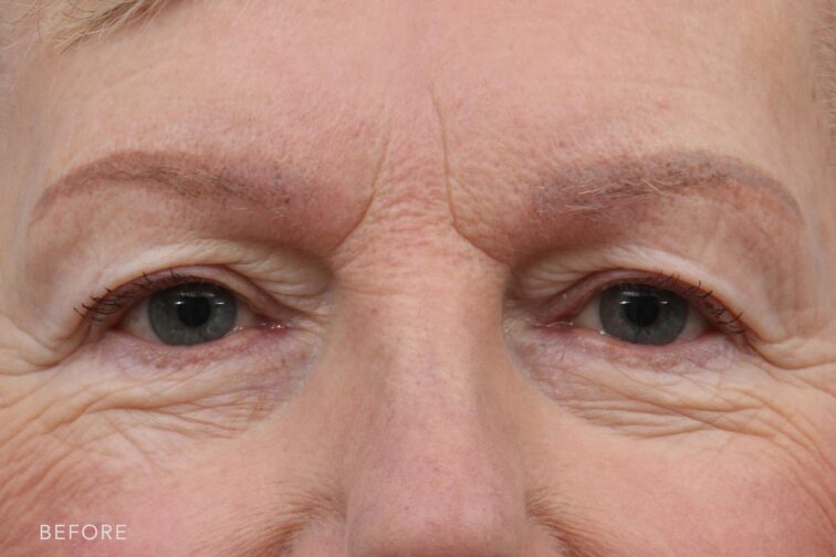 This is a photo of a woman's upper face with her baggy skin on her upper eyes. | Albany, Latham, Saratoga NY, Plastic Surgery