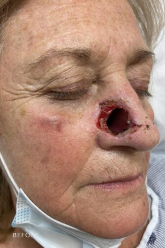 This is a photo of a woman's face with a blonde hair showing her open wound on her nose to perfom and repair tissue damage. | Albany, Latham, Saratoga NY, Plastic Surgery