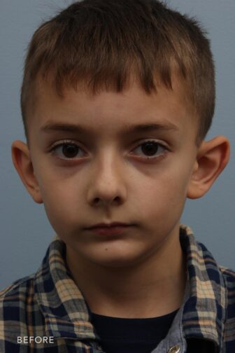 before photo of a young boy taken from the front angle before ear surgery. His ears stick out very far from his head.