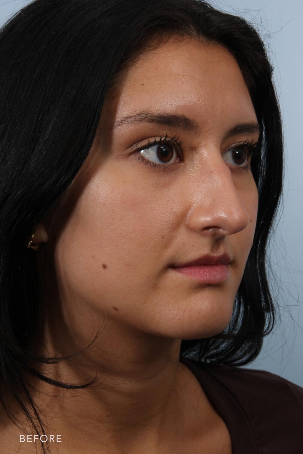 Rhinoplasty & Nasal Reconstruction Pictures | Williams Center Williams ...