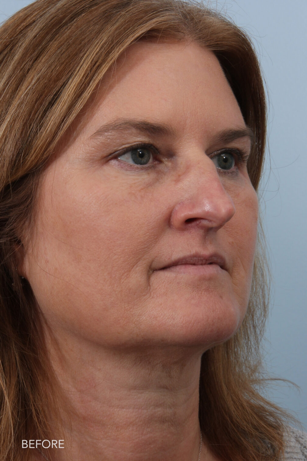 Rhinoplasty & Nasal Reconstruction Pictures | Williams Center Williams ...