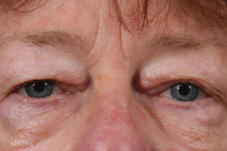 Before photo of a woman with heavy eyelids before eyelid surgery.