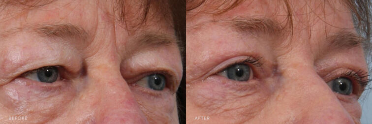 Side by side before and after of a woman's eyes from the oblique angle. Before surgery her upper eyelids were puffy and heavy weighing down the eyes. After surgery her eyes are much more open after the skin and fat deposits were removed. | Albany, Latham, Saratoga NY, Plastic Surgery