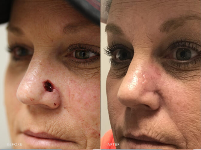 Left Nasal Defect procedure. Before photo shows a scar on her left nasal to remove facial skin cancer and to minimize tissue loss while after photo shows a reconstructed and repaired damaged tissue on her left nasal. | Albany, Latham, Saratoga NY, Plastic Surgery