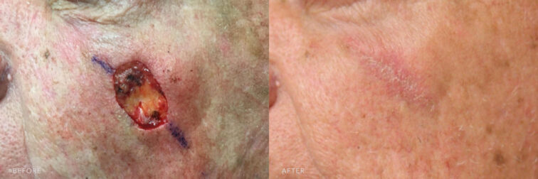 This is a side by side view photos of a man's face before and after Excesion of Left Facial Basal Cell Cancer with ATR and Excision of Back Seborrheic Keratosis procedure. Before photo shows an open wound to remove cell skin cancer in his left cheek while after photo shows his healing wound after the removal of cell skin cancer. | Albany, Latham, Saratoga NY, Plastic Surgery
