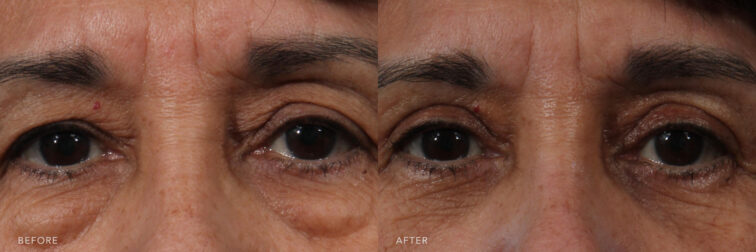 A photos of a woman's eyes before and after Excision of Excess Upper Eyelid Skin Bilaterally & Cosmetic Lower Eyelid Blepharoplasty with Fat Removal procedure. Before photo shows a droopy skin in her upper eyelid and baggy skin below her eyes while after photo shows a tighter and more upright skin sorrounding her eyes. | Albany, Latham, Saratoga NY, Plastic Surgery