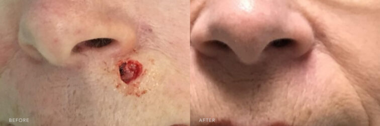 A photos of a woman's face before and after MOHs Reconstruction Upper Lip procedure. Before photo shows a skin defect on her upper lip while after photo shows a reconstructed skin to her upper lip and minimal damage to the skin tissues. | Albany, Latham, Saratoga NY, Plastic Surgery