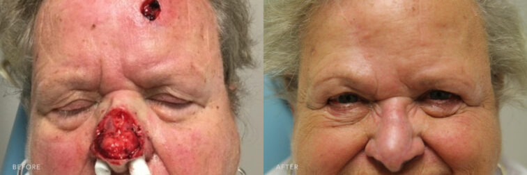 A photos of a woman's face before and after Reconstruction of Nasal Dorsum/Tip Defect and ATR of Forehead Defect procedure. Before photo shows an open wound in her forehead and nose in preparation for a cell skin defect removal while after photo shows a healed wound and reconstruted tip nose and forehead. | Albany, Latham, Saratoga NY, Plastic Surgery