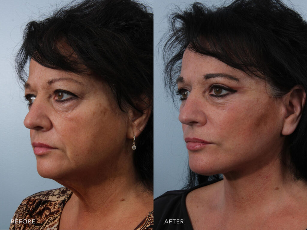 This is a side by side view photos of a woman's face before and after Deep Plane Lower Face and Neck Lift and Bilateral Upper Lid Sliver Blepharoplasty procedure. Before photo shows a loose-fitting skin on her cheeks that covers her jawline while after photo shows more solid skin which makes her jawline more vissible. | Albany, Latham, Saratoga NY, Plastic Surgery