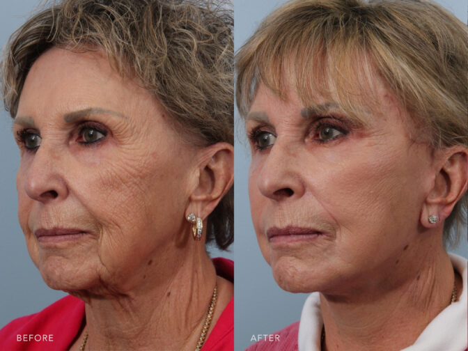 Facial Plastic Surgery Procedures