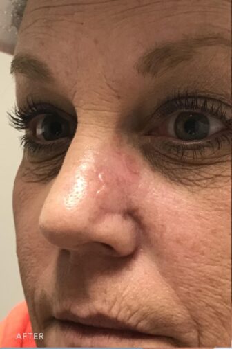 This is a photo of a woman's face with her reconstructed and repaired damaged tissue on her left nasal. | Albany, Latham, Saratoga NY, Plastic Surgery