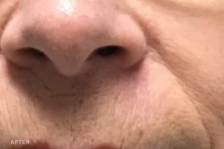 This is a photo of a woman's face with her reconstructed skin to her upper lip and minimal damage to the skin tissues. | Albany, Latham, Saratoga NY, Plastic Surgery