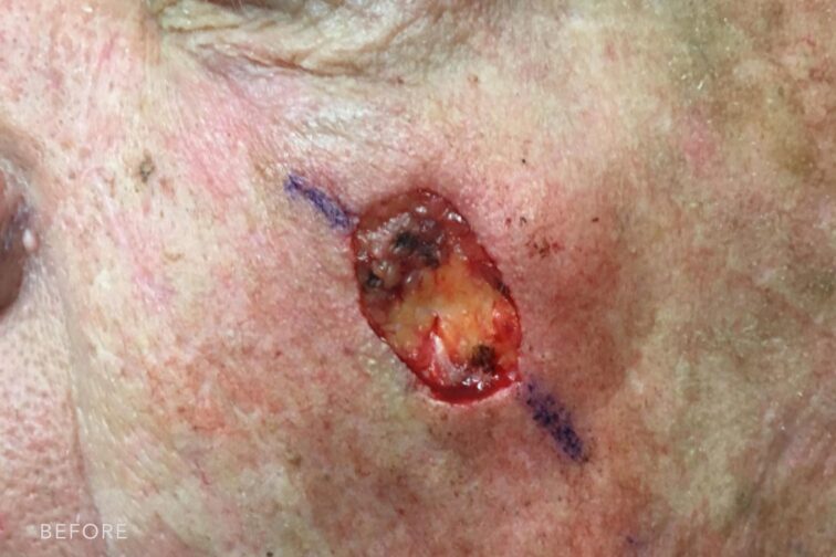 This is a photo of a man's face with his open wound to remove cell skin cancer in his left cheek. | Albany, Latham, Saratoga NY, Plastic Surgery