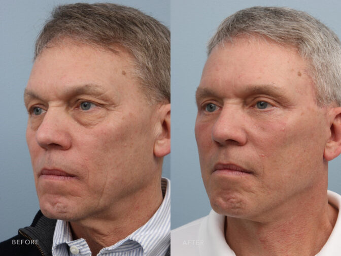 This is a side by side view photos of a man before and after Upper Lid Sliver Blepharoplasty procedure. Before photo shows excess skin on his upper eyes that partly covers his eyes while after photo shows more tighter skin on his upper eyes that makes a full shaped eyes. | Albany, Latham, Saratoga NY, Plastic Surgery