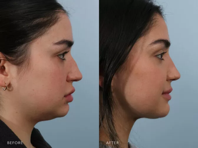 This is a side by side view photos of a woman before and after Endonasal Cosmetic Rhinoplasty and Submental Liposuction procedure. Before photo shows her bowed dorsum while after photo shows more upright angled dorsum. | Albany, Latham, Saratoga NY, Plastic Surgery