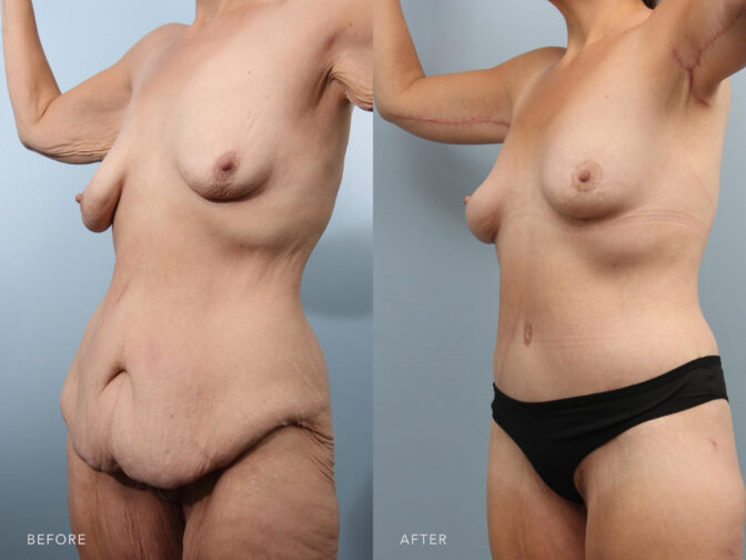 Side by side before and after of a woman's body from the oblique angle. Before body surgery her stomach hung over her pubic area with a lot of loose skin. After surgery her stomach is flat and smooth with the breasts lifted. | Albany, Latham, Saratoga NY, Plastic Surgery