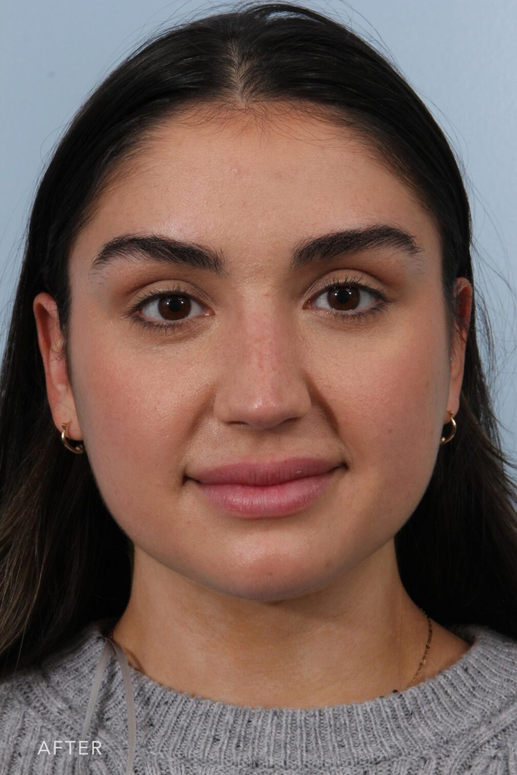 Rhinoplasty & Nasal Reconstruction Pictures | Williams Center Williams ...