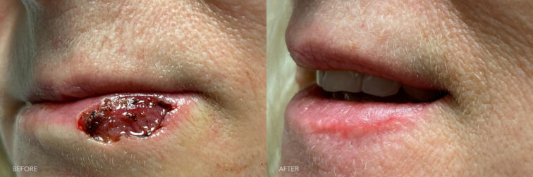 This is a side by side view photos of a woman's lower lip before and after Reconstruction of MOHs Left Lower Lip procedure. Before photo shows her left lower lip defect while after photo shows her reconstructed lower lip with minimized lip tissue loss. | Albany, Latham, Saratoga NY, Plastic Surgery