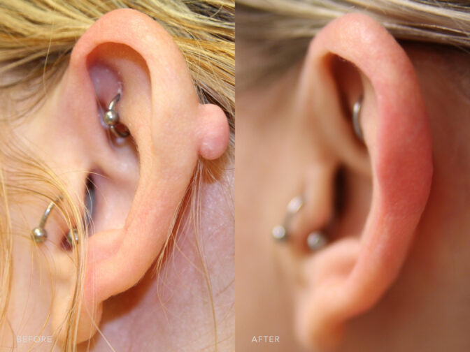 This si a side by side view photos of a woman's ear before and after Excision of Left Ear Keloid procedure. Before photo shows a thick scar tissue on her left ear while after photo shows smoother and scarless ear. | Albany, Latham, Saratoga NY, Plastic Surgery