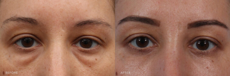 Side by side before and after of a womans eyes very close up. She had very heavy and puffy under eyes before having blepharoplasty surgery. Now her under eyes are smooth and youthful.
