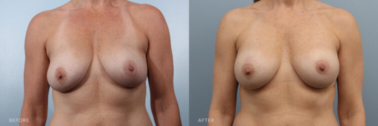 A photos of a woman's upper body before and after Bilateral Breast Implant Removal procedure. Before photo shows a breasts that seem to sit lower on the chest and the nipples pointing downwards while after photo shows more volume to her breasts and having a narrow top and full at the bottom. | Albany, Latham, Saratoga NY, Plastic Surgery