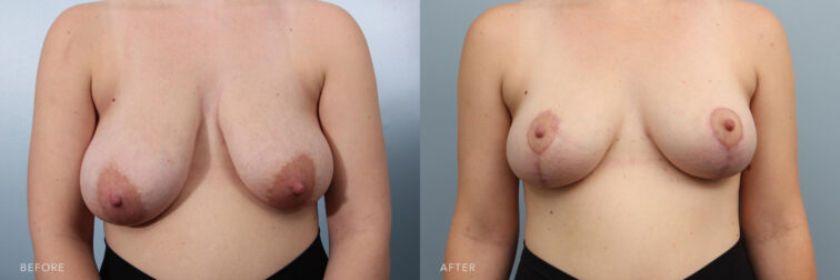 A photos of a woman's body before and after Bilateral Mastopexy procedure. Before photo shows increased volume and weight of her breasts tissue which caused her breasts to sag while after photo shows a lifted breasts with her removed excess skin and tightened tissues. | Albany, Latham, Saratoga NY, Plastic Surgery