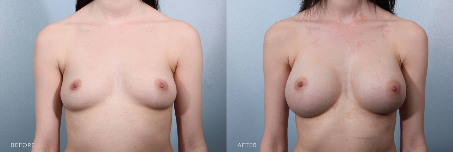 A photo of a woman's upper body before and after the Breast Augmentation procedure. The before picture shows a flat chest profile with her breasts sitting closer to her ribcage with a little outward projection. The after photo shows a round and symmetrical shape, with her breasts appearing evenly shaped and a smooth, well-contoured form. | Albany, Latham, Saratoga NY, Plastic Surgery
