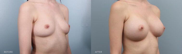 Breast augmentation side by side showing a woman with small breasts before surgery to perfect round and lifted breasts after surgery. | Albany, Latham, Saratoga, NY, Plastic Surgery