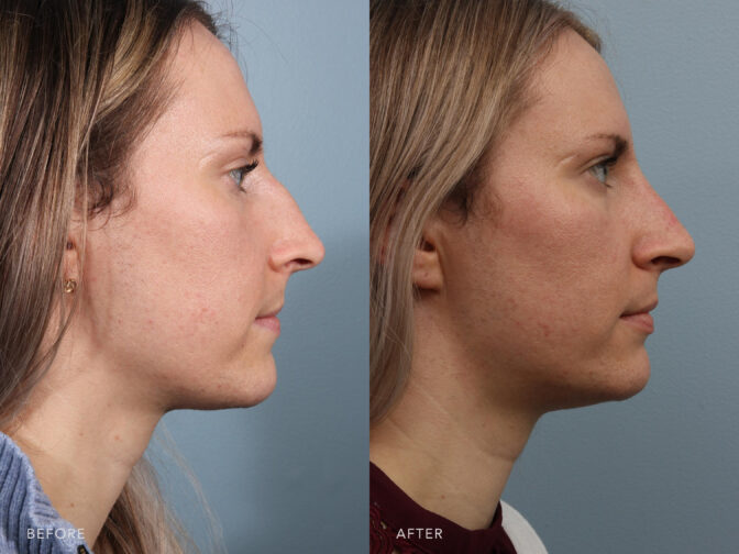 This is a side by side view photos of a woman before and after Endonasal Cosmetic Rhinoplasty and Open Reduction of Nasal Fractures procedure. Before photo shows her crooked and craggy dorsum while after photo shows her straightened and more alligned dorsum. | Albany, Latham, Saratoga NY, Plastic Surgery