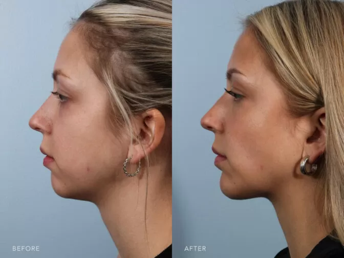 This is a side by side view photos of a woman before and after Submental Liposuction, Chin Augmentation and Bilateral Buccal Fat removal procedure. Before photo shows excess fat to her neck and jawline while after photo shows more firm and tightened up skin along her neck and jawline. | Albany, Latham, Saratoga NY, Plastic Surgery