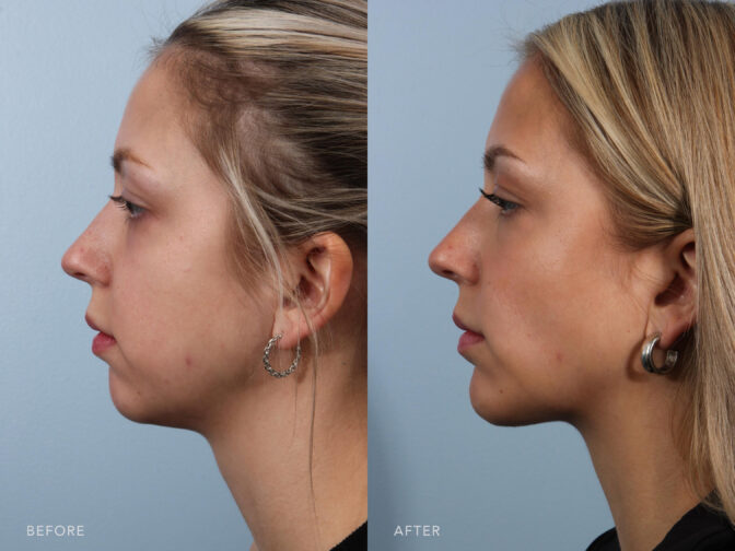 This is a side by side view photos of a woman before and after Submental Liposuction, Chin Augmentation and Bilateral Buccal Fat removal procedure. Before photo shows excess fat to her neck and jawline while after photo shows more firm and tightened up skin along her neck and jawline. | Albany, Latham, Saratoga NY, Plastic Surgery