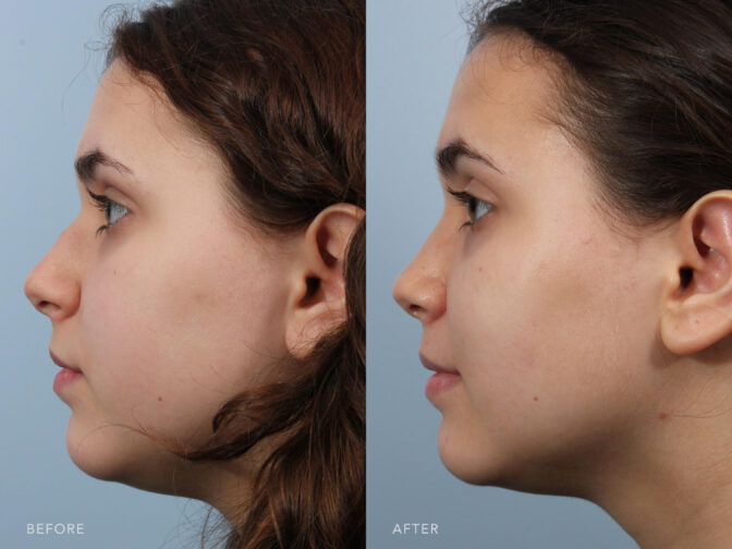 This is a side by side view photos of a woman before and after Endonasal Functional and Cosmetic Rhinoplasty procedure. Before photo shows a rounded tip nose. While after photo shows more pointed and equally shaped nose. | Albany, Latham, Saratoga NY, Plastic Surgery