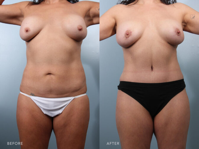 A photos of a woman's body before and after Abdominoplasty with Liposuction procedure. Before photo shows a pocket of skin and fat in her lower abdomen while after photo shows a toned out and flat abdomen. | Albany, Latham, Saratoga NY, Plastic Surgery