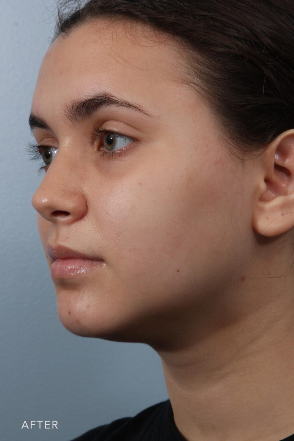 Rhinoplasty & Nasal Reconstruction Pictures | Williams Center Williams ...