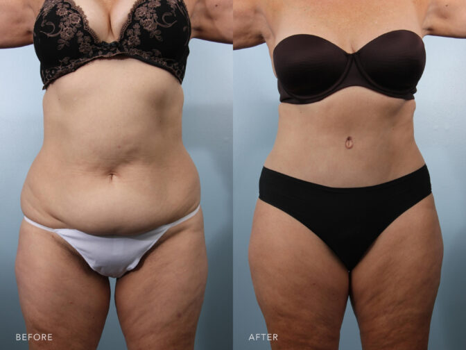 A photos of a woman's body before and after Abdominoplasty and Liposuction procedure. Before photo shows loose skin and excess fats in her abdomen while after photo shows a well countoured skin and tightened muscles around her abdomen. | Albany, Latham, Saratoga NY, Plastic Surgery