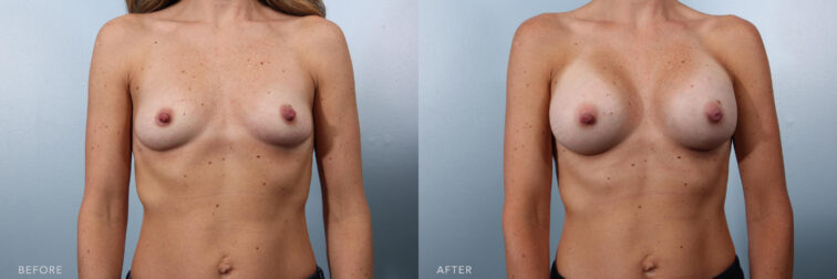 A photos of a woman's body before and after Breast Augmentation procedure. Before photo shows her upper torso with no or little curvature while after photo shows more improved, restored balance and proportion on her body. | Albany, Latham, Saratoga NY, Plastic Surgery