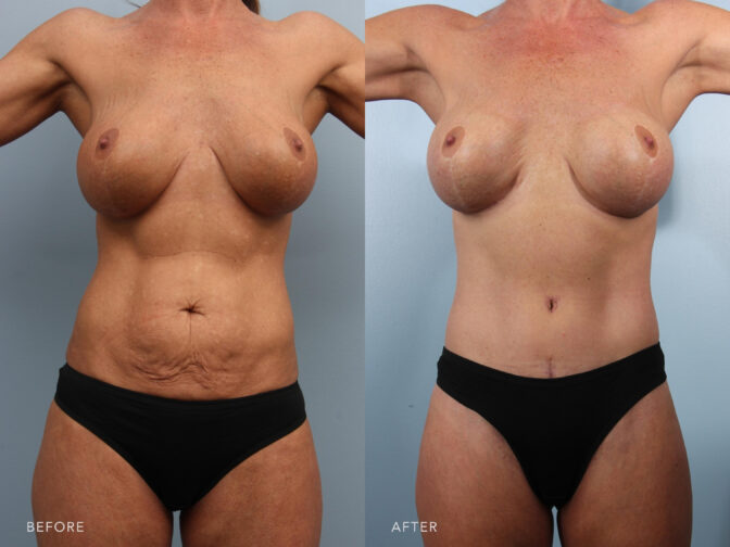 A photos of woman's body before and after Abdominoplasty with Liposuction procedure. Before photo shows her unevenly shaped and wrinkled abdomen while after photo shows a flatter abdomen and more proportioned midsection. | Albany, Latham, Saratoga NY, Plastic Surgery