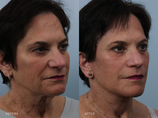 This is a side by side view photos of a woman's face before and after Deep Plane Lower Face and Neck Lift procedure. Before photo shows a lost volume and collagen in her skin that caused wrinkles and aging face while after photo shows her addressed skin laxity in her midface through the neck and restored youthful plumpness. | Albany, Latham, Saratoga NY, Plastic Surgery