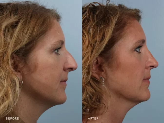 A side by side view photos of a woman before and after Endonasal Cosmetic Rhinoplasty procedure. Before photo shows a bowed and curvy nose while after photo shows a concave nose shape. | Albany, Latham, Saratoga NY, Plastic Surgery