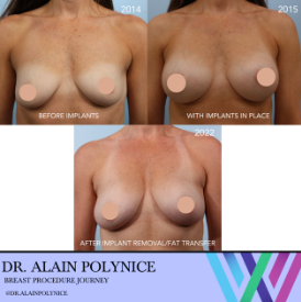 Results of breast implant removal