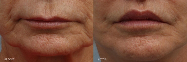 A photos of a woman's lower face before and after Lip Lift procedure. Before photo shows her tired lips leaving her lips to look thin while after photo shows her restored youthful-looking lips. | Albany, Latham, Saratoga NY, Plastic Surgery
