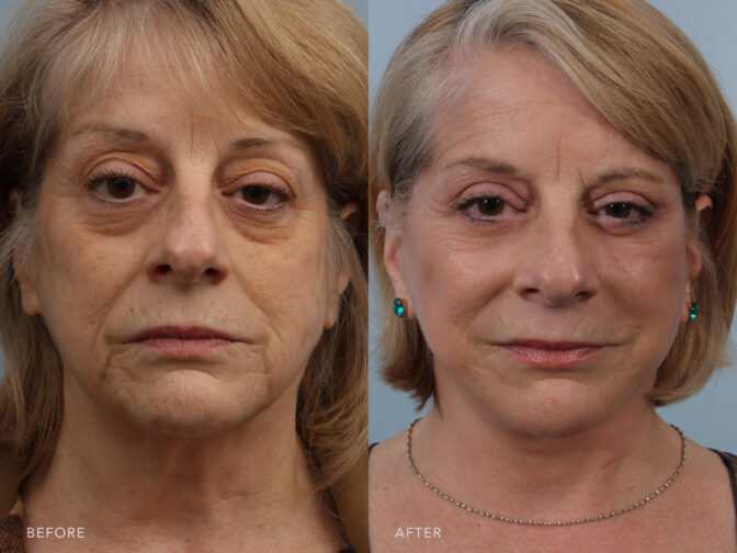 A photos of a woman's face before and after Deep Plane Lower Face and Neck Lift procedure. Before photo shows a thin skin and less elastic that caused her skin to naturally fold while after photo shows a restored and more youthful appearance. | Albany, Latham, Saratoga NY, Plastic Surgery