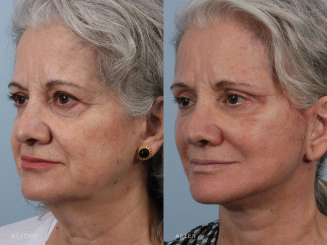 This is a side by side view photos of a woman's face before and after Deep Plane Lower Face and Neck Lift with Buccal Fad Pad Removal. Before photo shows a rounded mass of fats in her mid face while after photo shows a thinner cheeks and well defined facial angle. | Albany, Latham, Saratoga NY, Plastic Surgery