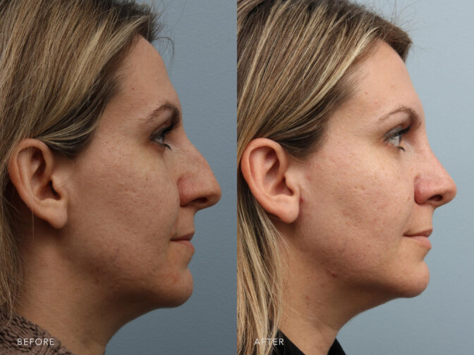 This is a side by side view photos of a woman's face before and after Endonasal Cosmetic Rhinoplasty and Fat Grafting procedure. Before photo shows deformity in her nasal septum while after photo shows a readjusted bone and cartilage. | Albany, Latham, Saratoga NY, Plastic Surgery